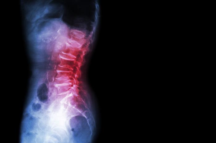 Рентгенова снимка болки в гърба